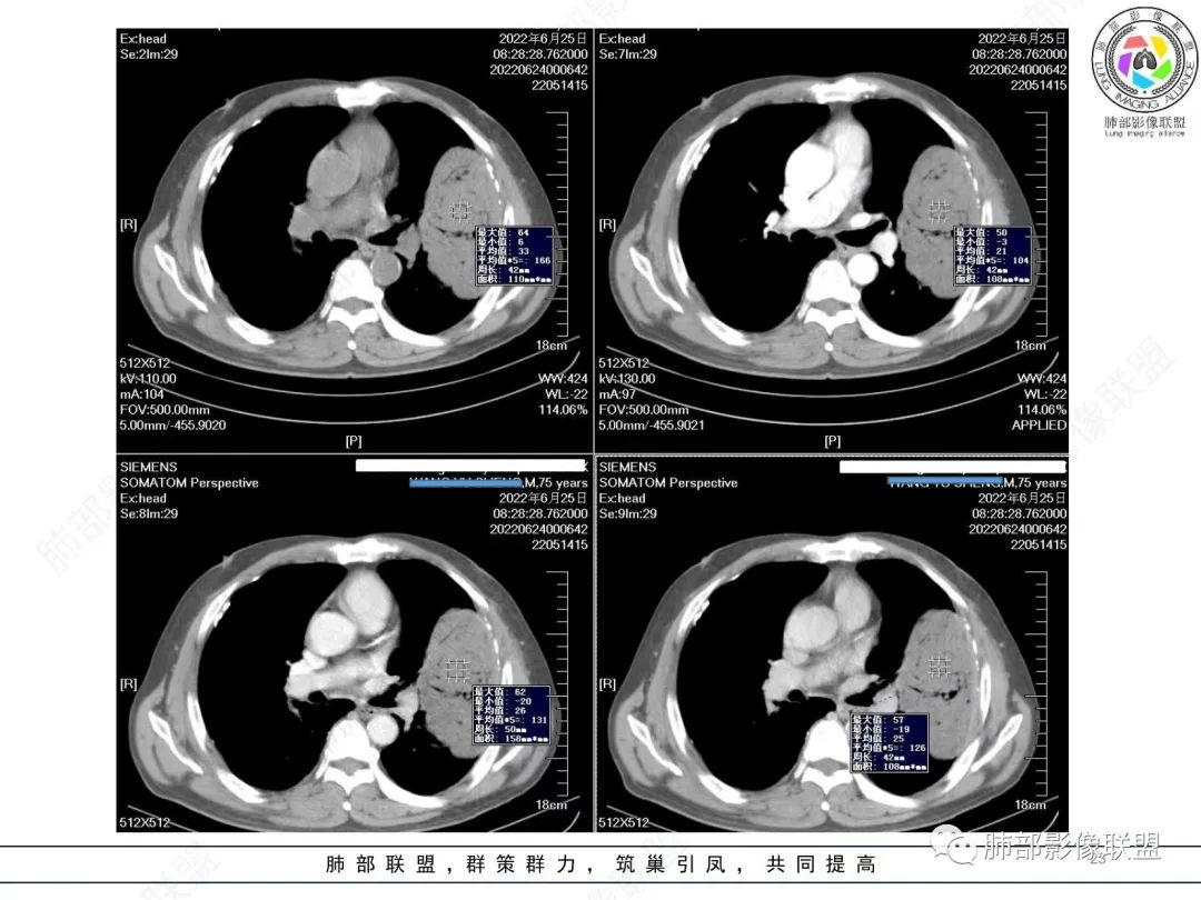 【病例】肺部硕大块影一定想到它！-22