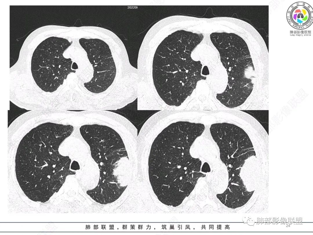 【病例】肺部硕大块影一定想到它！-23