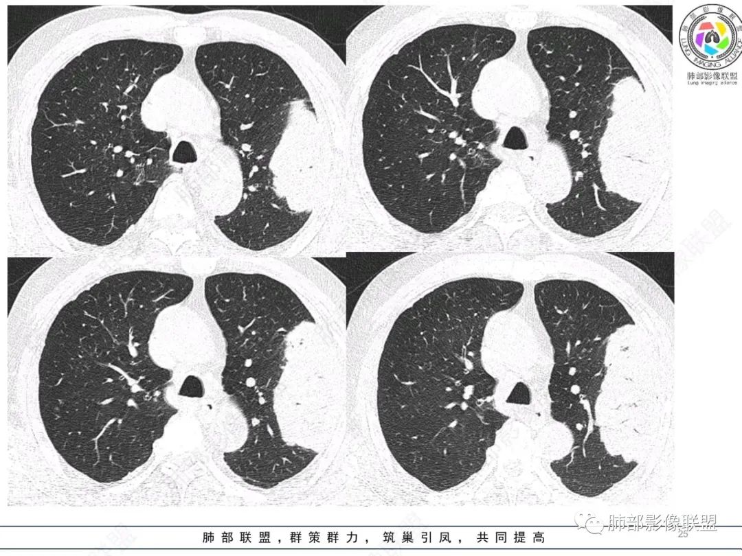 【病例】肺部硕大块影一定想到它！-24
