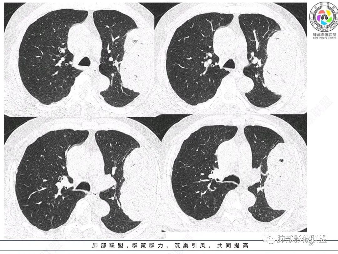 【病例】肺部硕大块影一定想到它！-25