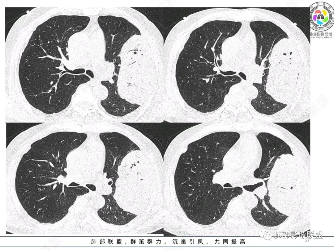 【病例】肺部硕大块影一定想到它！-26