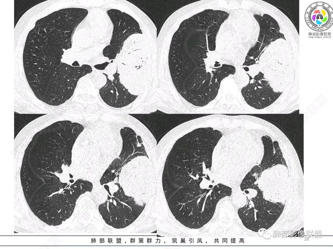 【病例】肺部硕大块影一定想到它！-27
