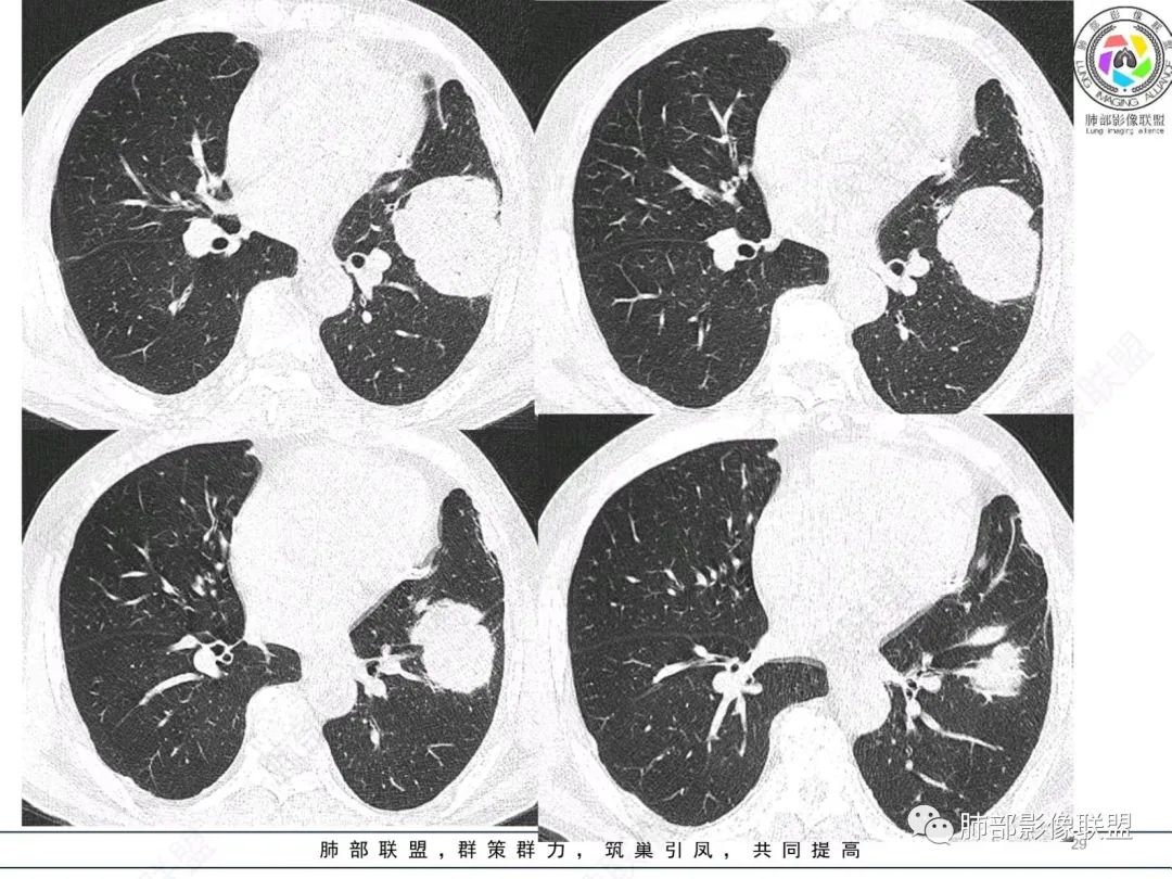 【病例】肺部硕大块影一定想到它！-28