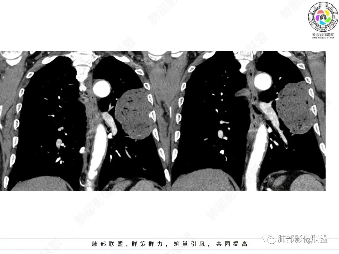 【病例】肺部硕大块影一定想到它！-30
