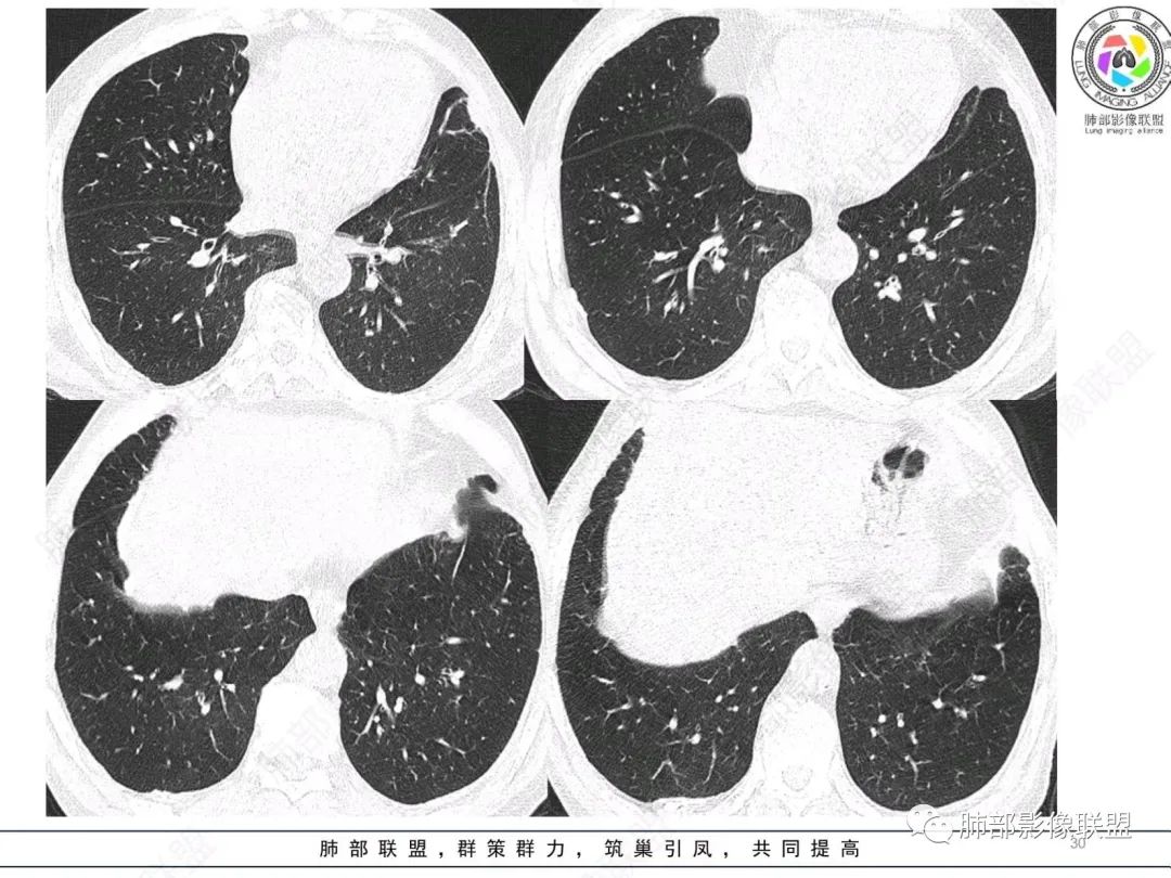 【病例】肺部硕大块影一定想到它！-29