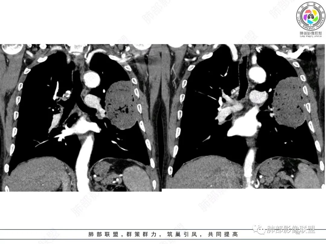 【病例】肺部硕大块影一定想到它！-31