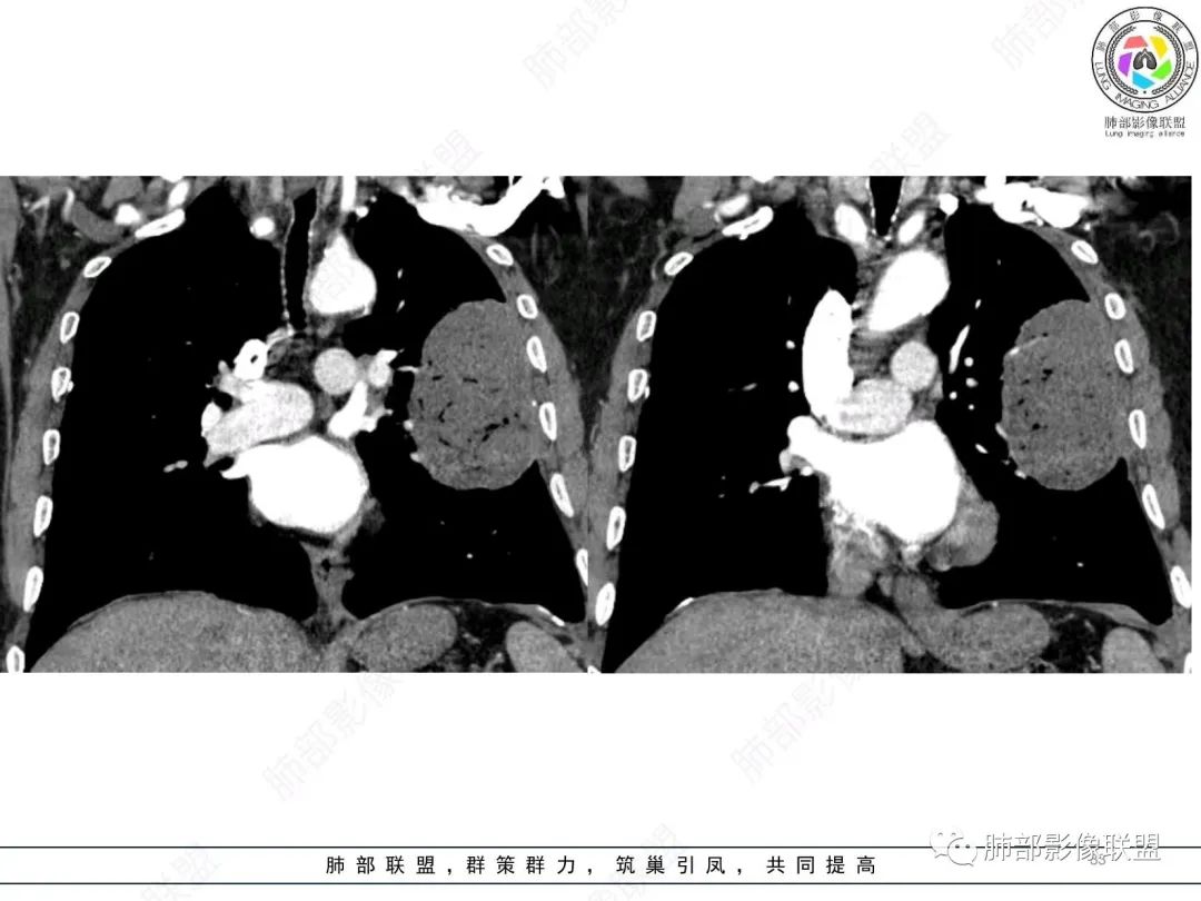 【病例】肺部硕大块影一定想到它！-32