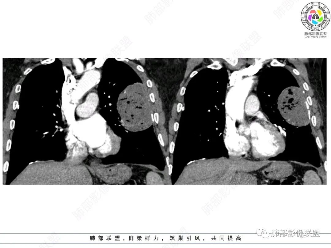 【病例】肺部硕大块影一定想到它！-33
