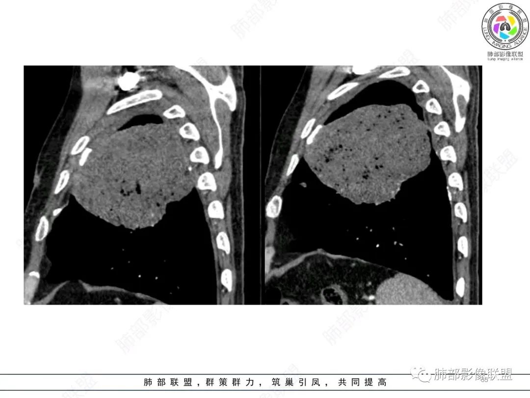 【病例】肺部硕大块影一定想到它！-34