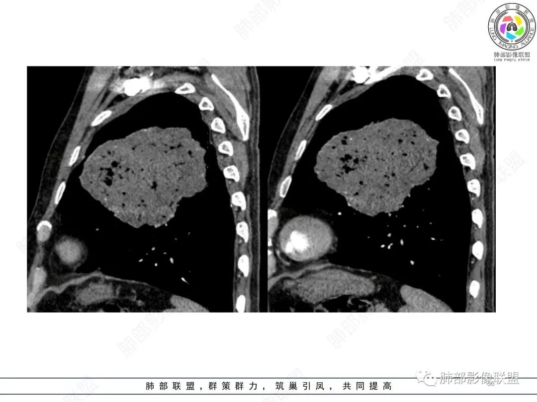 【病例】肺部硕大块影一定想到它！-35