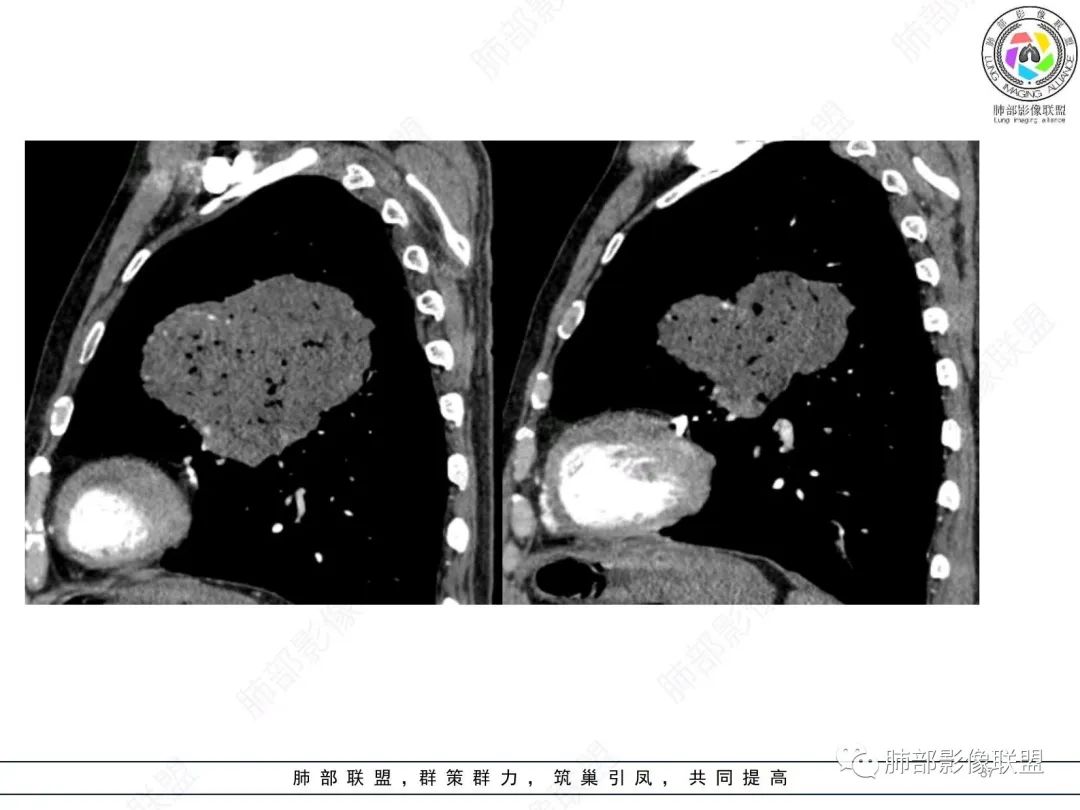 【病例】肺部硕大块影一定想到它！-36