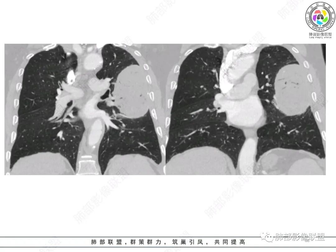 【病例】肺部硕大块影一定想到它！-37