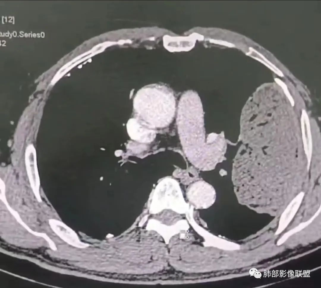 【病例】肺部硕大块影一定想到它！-39
