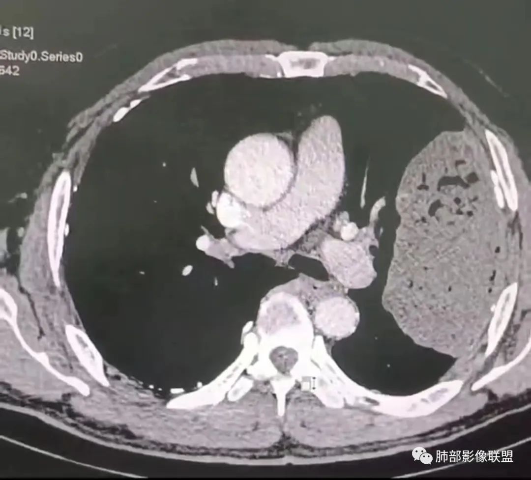 【病例】肺部硕大块影一定想到它！-40