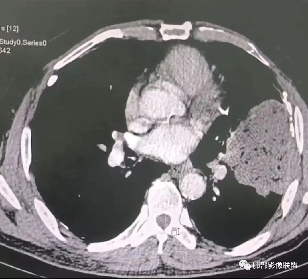 【病例】肺部硕大块影一定想到它！-41