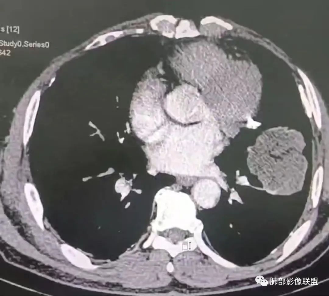 【病例】肺部硕大块影一定想到它！-42
