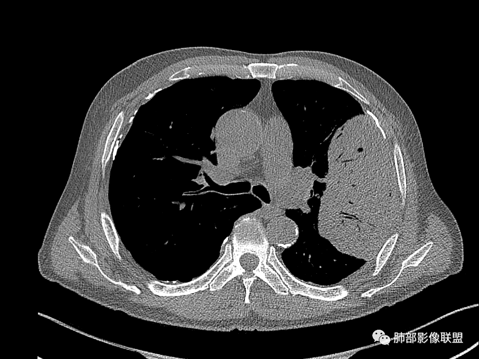 【病例】肺部硕大块影一定想到它！-43