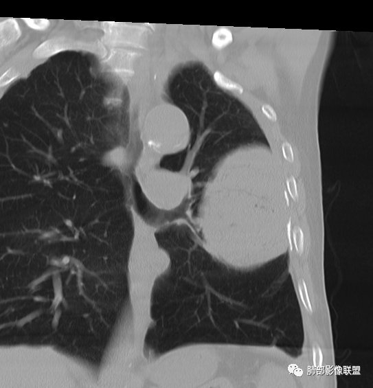 【病例】肺部硕大块影一定想到它！-44