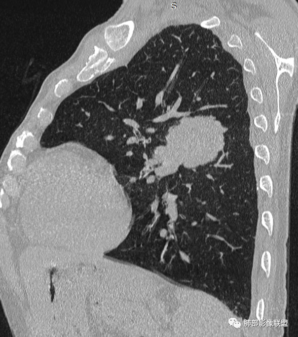 【病例】肺部硕大块影一定想到它！-45
