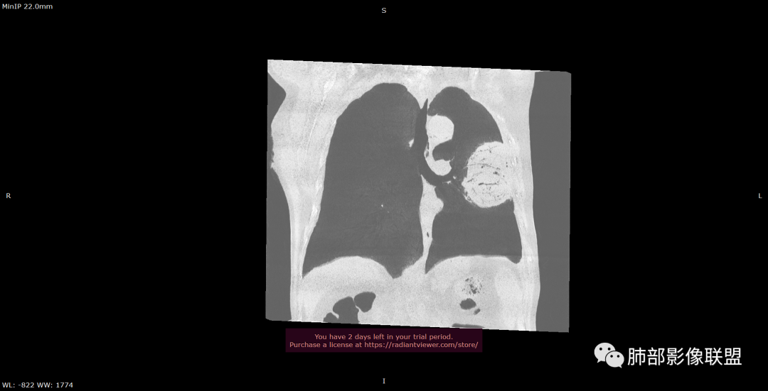 【病例】肺部硕大块影一定想到它！-46