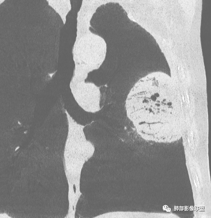 【病例】肺部硕大块影一定想到它！-47