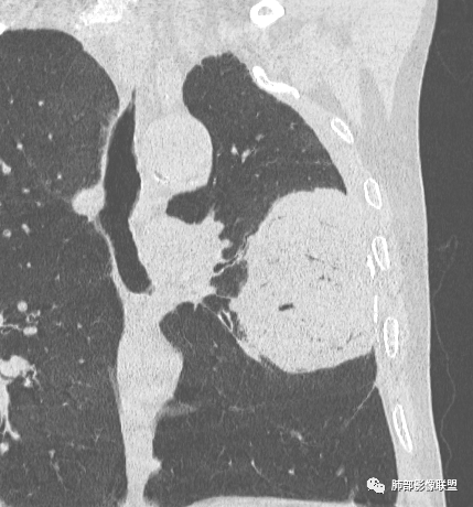 【病例】肺部硕大块影一定想到它！-48