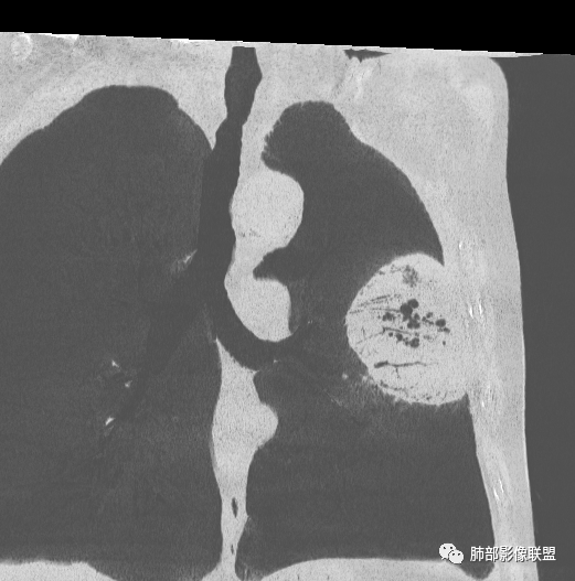 【病例】肺部硕大块影一定想到它！-49