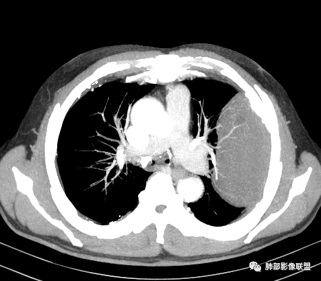【病例】肺部硕大块影一定想到它！-50