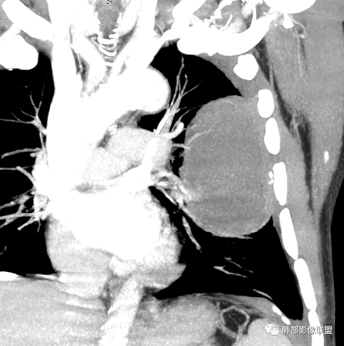 【病例】肺部硕大块影一定想到它！-51