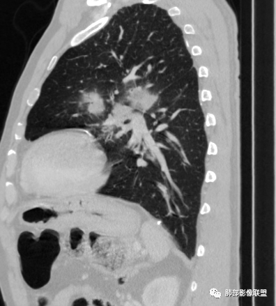 【病例】肺部硕大块影一定想到它！-52