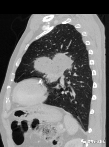 【病例】肺部硕大块影一定想到它！-53