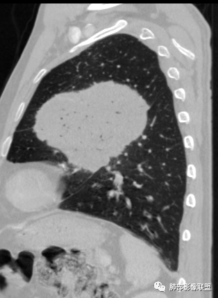 【病例】肺部硕大块影一定想到它！-54