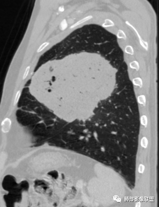 【病例】肺部硕大块影一定想到它！-55