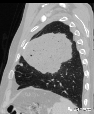 【病例】肺部硕大块影一定想到它！-56
