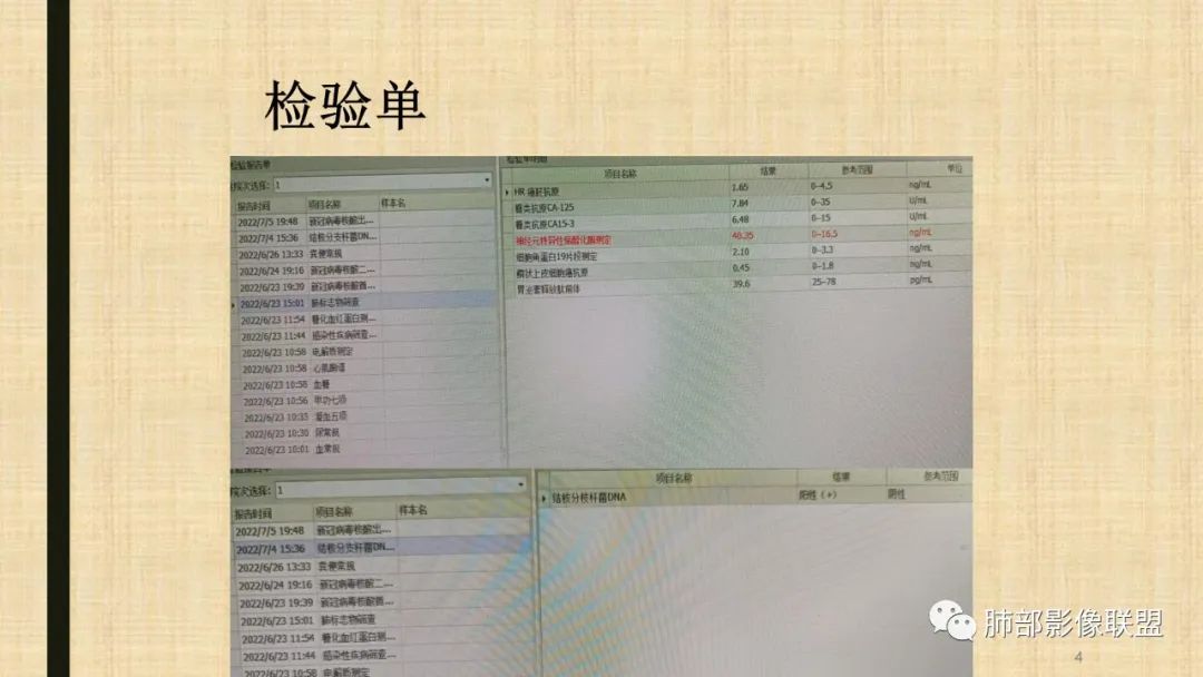 【病例】肺部硕大块影一定想到它！-61