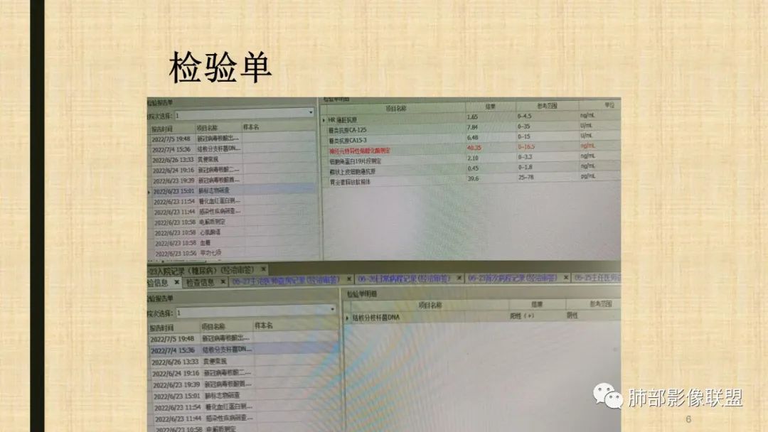 【病例】肺部硕大块影一定想到它！-63