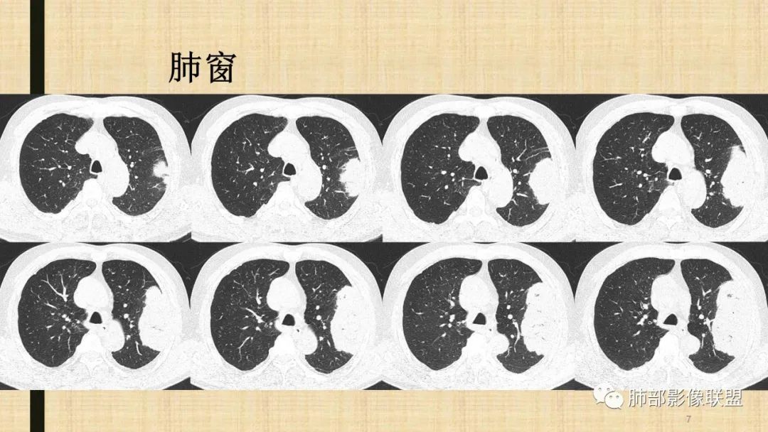 【病例】肺部硕大块影一定想到它！-64