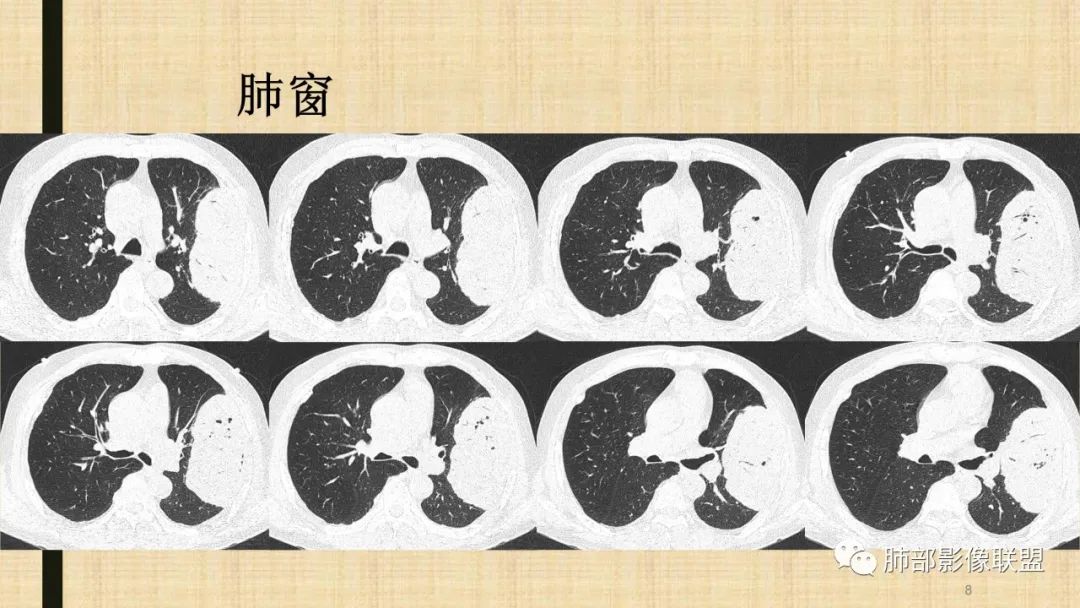 【病例】肺部硕大块影一定想到它！-65