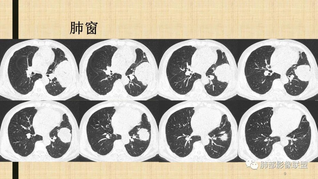 【病例】肺部硕大块影一定想到它！-66
