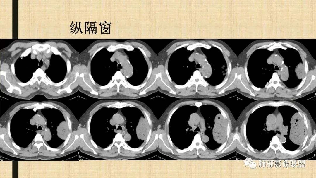 【病例】肺部硕大块影一定想到它！-67