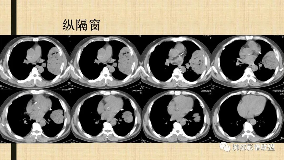 【病例】肺部硕大块影一定想到它！-68