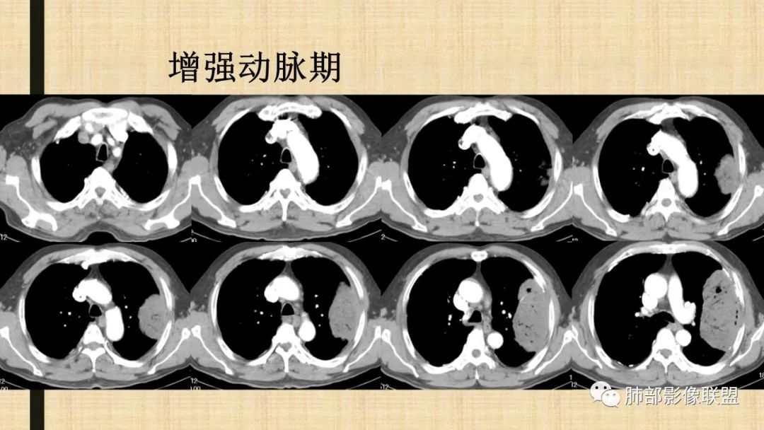 【病例】肺部硕大块影一定想到它！-69