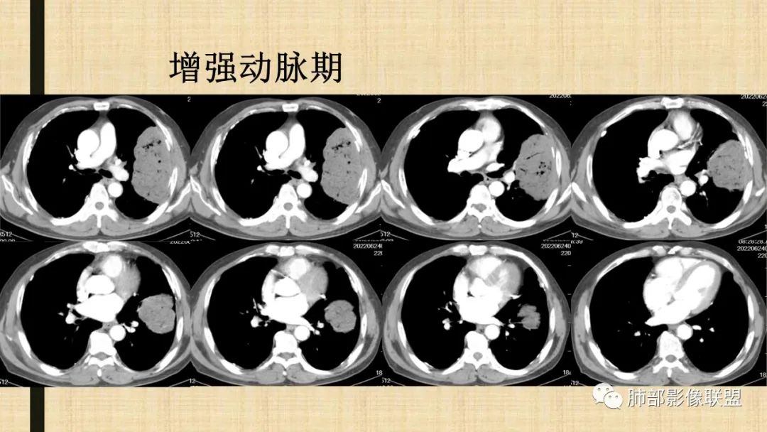 【病例】肺部硕大块影一定想到它！-70