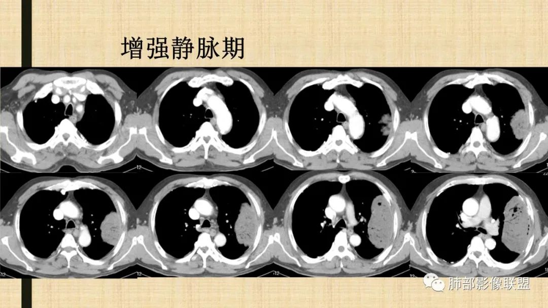 【病例】肺部硕大块影一定想到它！-71