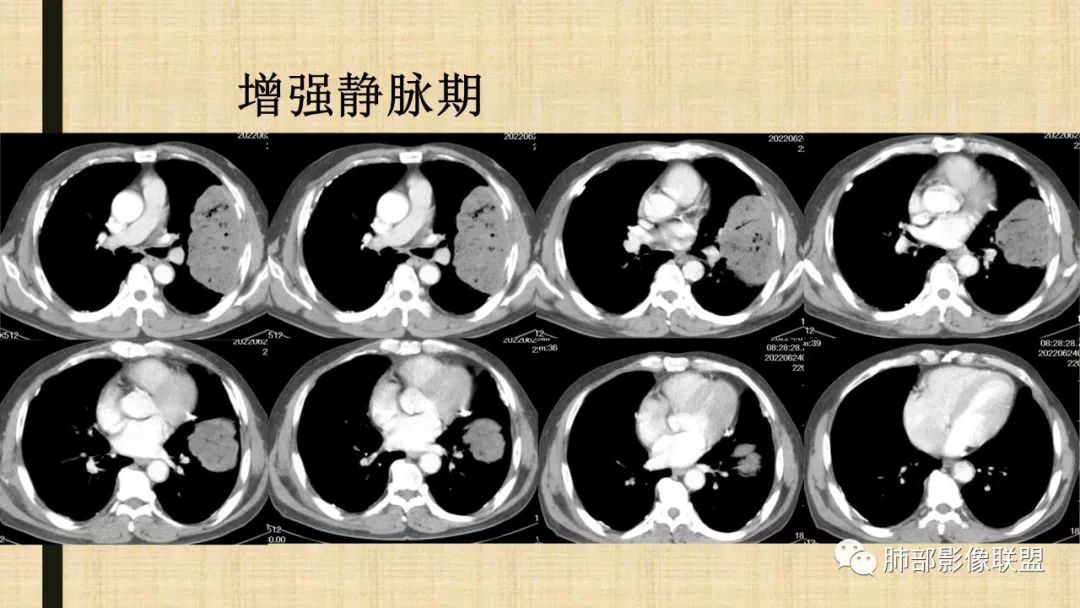 【病例】肺部硕大块影一定想到它！-72