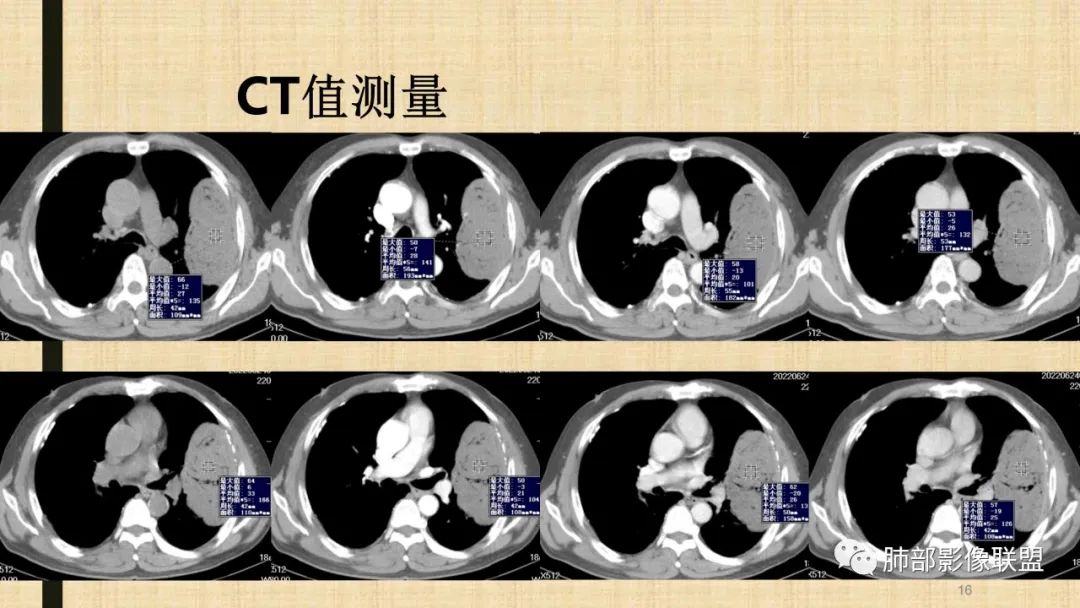 【病例】肺部硕大块影一定想到它！-73