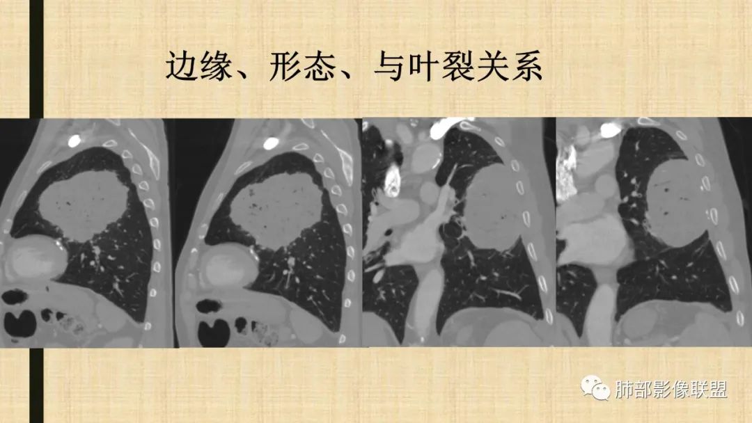 【病例】肺部硕大块影一定想到它！-74