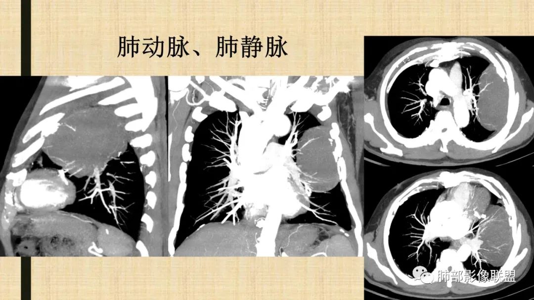 【病例】肺部硕大块影一定想到它！-75