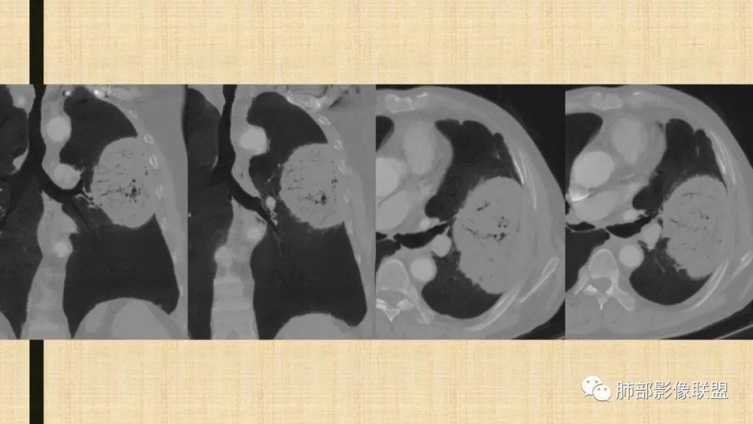 【病例】肺部硕大块影一定想到它！-76