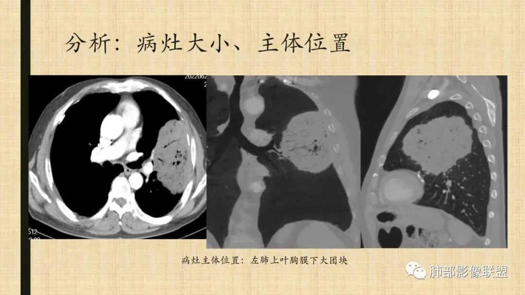 【病例】肺部硕大块影一定想到它！-77